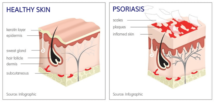 plaque psoriasis strep)